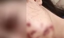 Komşu İlde Genç Kızın Yüzüne Maytap Patladı