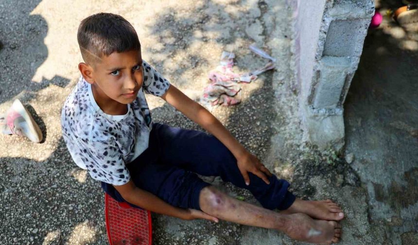 Kaza sonrası ayağı yanlış kaynadı, hayatı kaykay üzerinde geçiyor